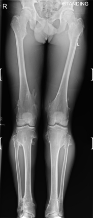 Hereditary multiple exostoses (HME) | Radiology Case | Radiopaedia.org