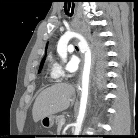 Thoracic Aortic Injury Radiology Reference Article Radiopaedia Org