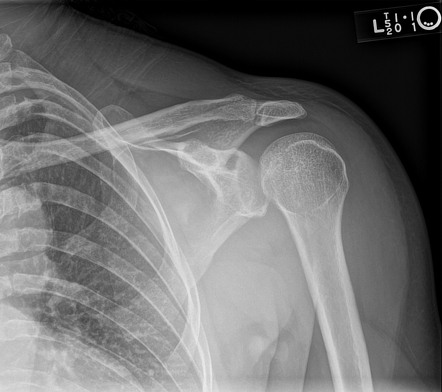 Posterior glenohumeral dislocation | Radiology Case | Radiopaedia.org