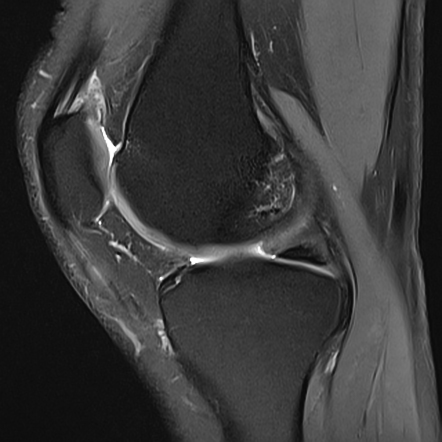 Intratendinous ganglion cyst of patellar tendon | Radiology Case ...