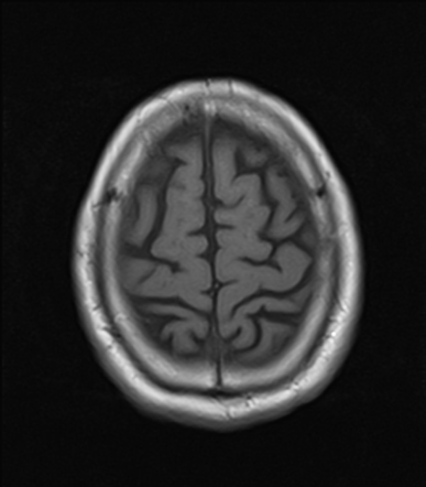 acute stroke case study