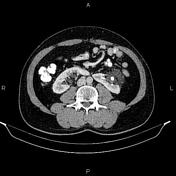 Horseshoe kidney, Radiology Reference Article