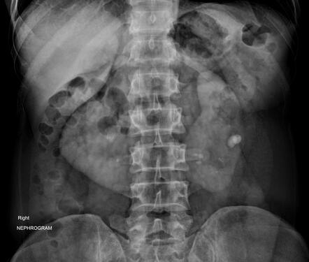 Pyelonephritis in horseshoe kidney | Image | Radiopaedia.org