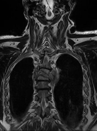 Tuberculous Spondylodiscitis | Radiology Case | Radiopaedia.org