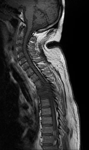 Tuberculous spondylodiscitis | Image | Radiopaedia.org