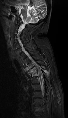 Tuberculous Spondylodiscitis | Image | Radiopaedia.org