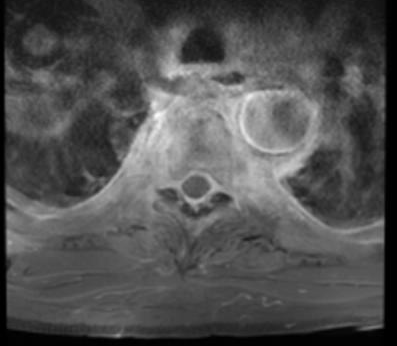 Tuberculous Spondylodiscitis | Image | Radiopaedia.org