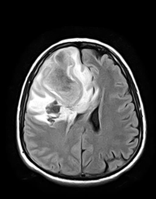 case presentation on brain abscess