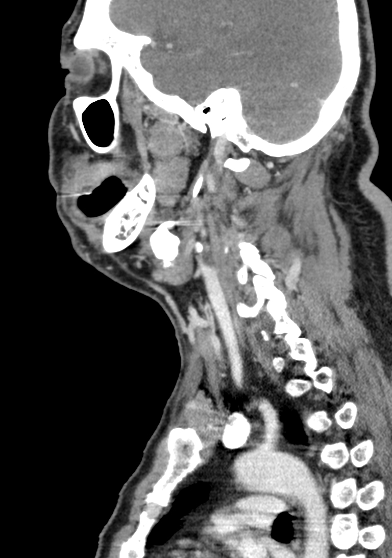 Left Submandibular Sialolithiasis Image