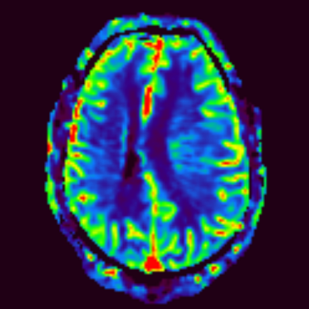 Astrocytoma, IDH-mutant - grade 3 - gliomatosis growth pattern ...