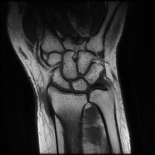 De Quervain tenosynovitis MRI Image