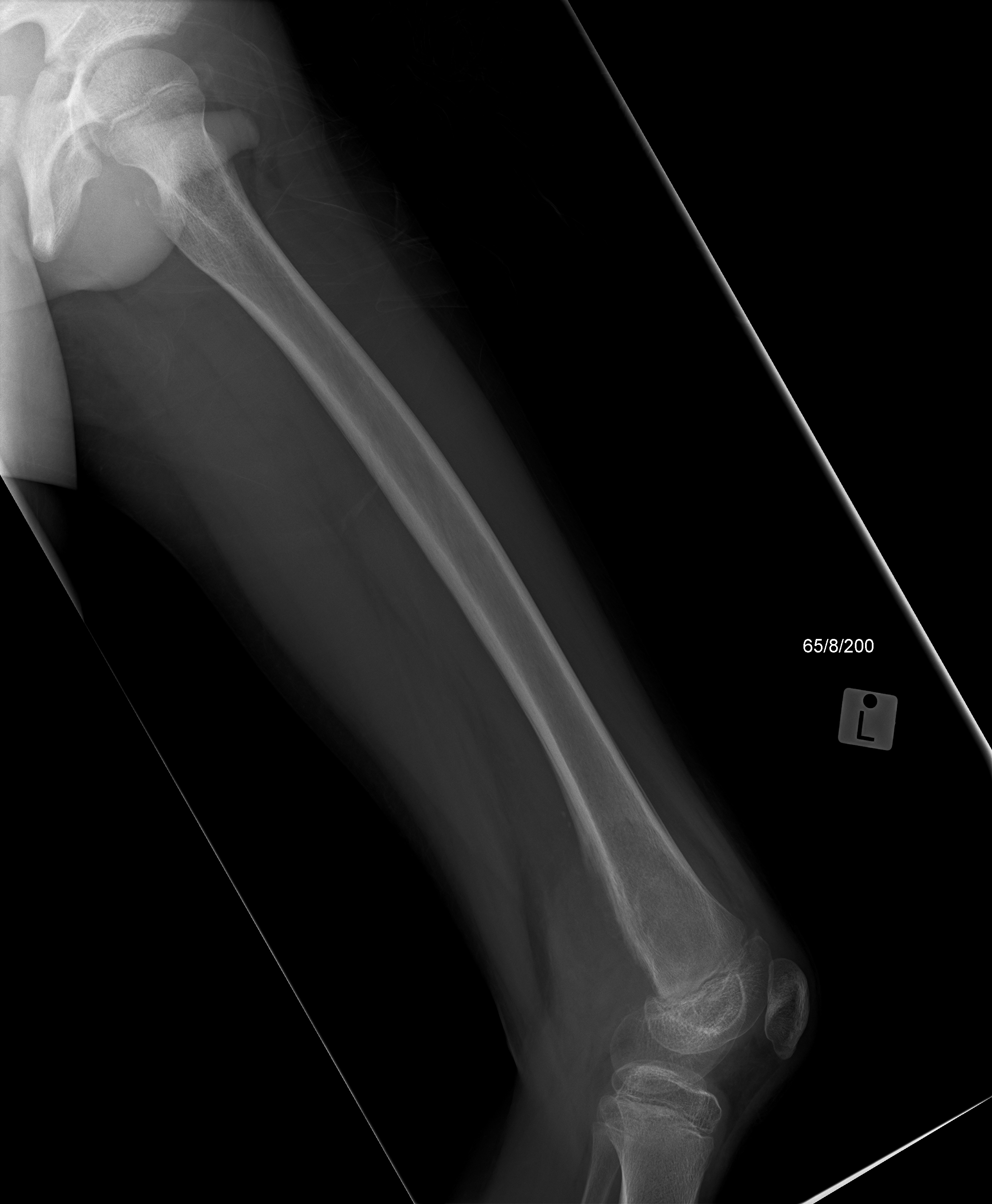 Osteosarcoma | Image | Radiopaedia.org