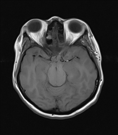 Meningiomatosis | Radiology Case | Radiopaedia.org