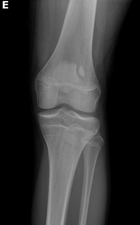 Bipartite patella | Radiology Case | Radiopaedia.org