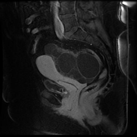 Ovarian serous cystadenofibroma | Image | Radiopaedia.org