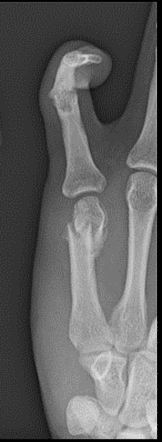 Boxer S Fracture Radiology Case Radiopaedia Org