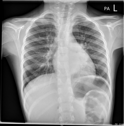 Round pneumonia | Radiology Case | Radiopaedia.org