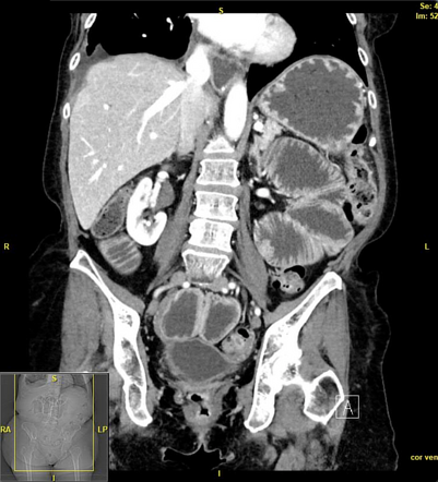 Hide-bound sign (bowel) | Radiology Reference Article | Radiopaedia.org