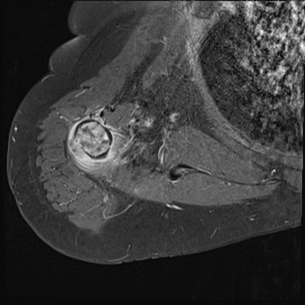 Angiosarcoma (bone) | Radiology Reference Article | Radiopaedia.org