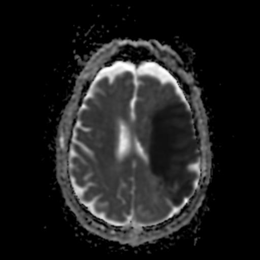 MCA territory infarct | Image | Radiopaedia.org