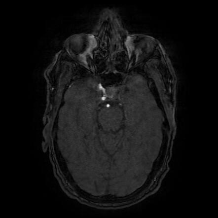 MCA territory infarct | Image | Radiopaedia.org