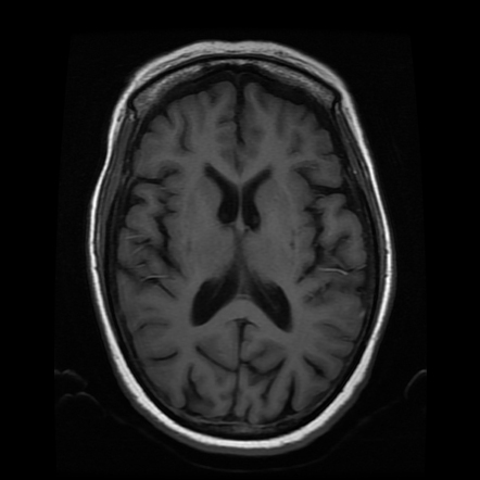 Multisystem Atrophy | Image | Radiopaedia.org