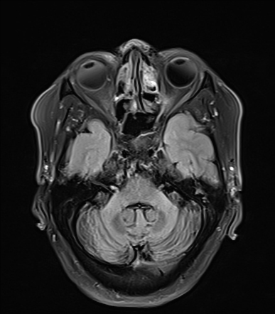 multiple system atrophy case study