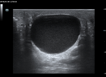 Spermatocele | Image | Radiopaedia.org