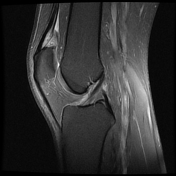 Tag: anterior suprapatellar fat pad impingement syndrome | Radiopaedia.org