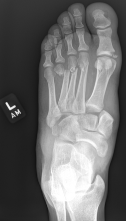 Lisfranc injury - type A homolateral complete incongruity | Radiology ...