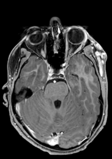 Temporal subcutaneous high-flow arteriovenous malformation | Image ...