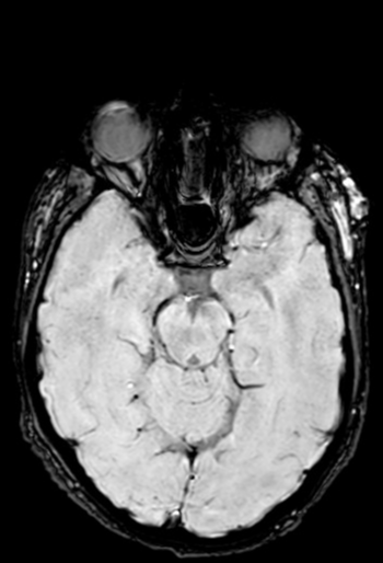 Temporal Subcutaneous High Flow Arteriovenous Malformation Image