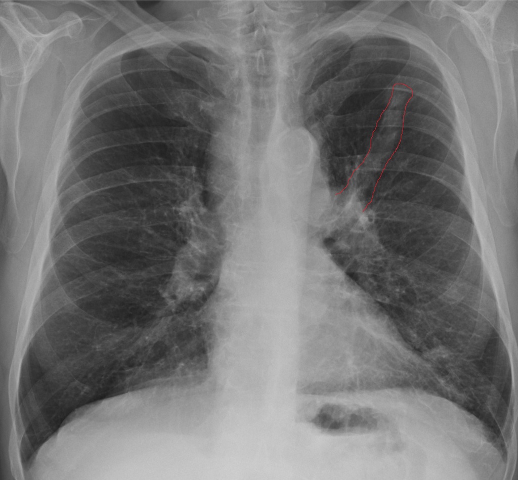 chest xray cancer