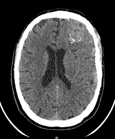 Cerebral arteriovenous malformation | Radiology Case | Radiopaedia.org