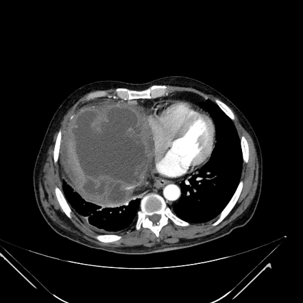 Hepatic dome hydatid cyst rupture | Image | Radiopaedia.org