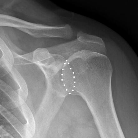 Loss of normal half-moon overlap sign (shoulder) | Radiology Reference ...