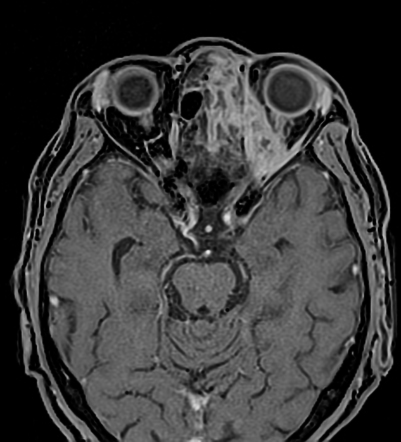 Rhino-orbito-cerebral mucormycosis | Image | Radiopaedia.org