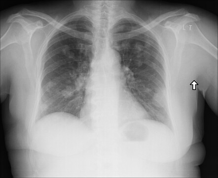 Lung metastases from rectal carcinoma | Radiology Case | Radiopaedia.org