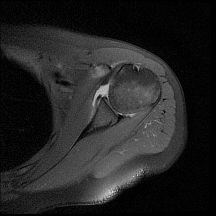 Hill-sachs Defect With Bankart Lesion 