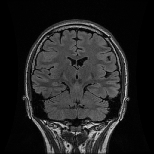 Multinodular and vacuolating neuronal tumor | Image | Radiopaedia.org