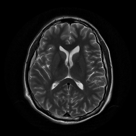 Multinodular and vacuolating neuronal tumor | Radiology Case ...