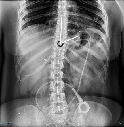 Gastric band slippage | Radiology Reference Article | Radiopaedia.org