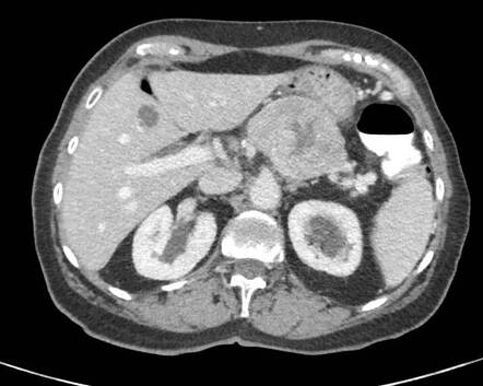 Pancreatic Neuroendocrine Tumour | Radiology Case | Radiopaedia.org