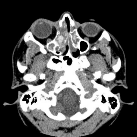 Fungal sinusitis | Radiology Case | Radiopaedia.org