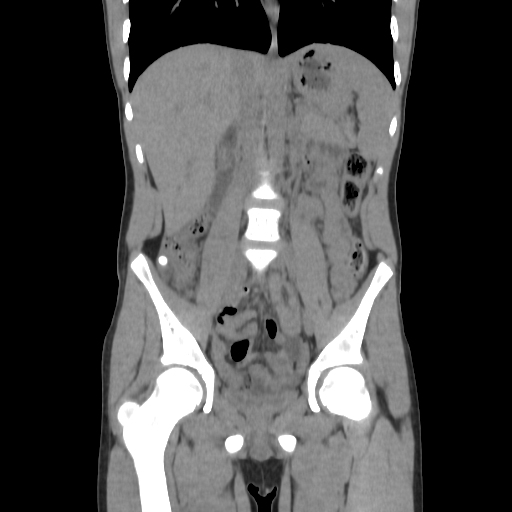 Tip appendicitis | Image | Radiopaedia.org