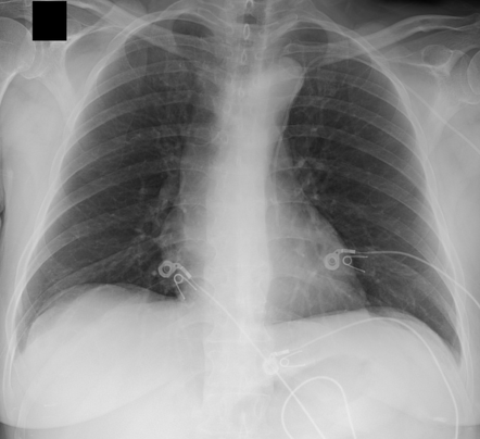 Left sided superior vena cava | Radiology Case | Radiopaedia.org