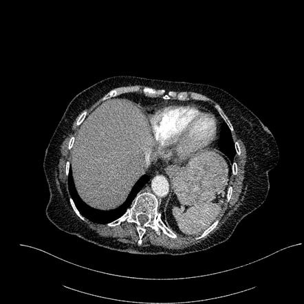 Zollinger Ellison syndrome | Radiology Case | Radiopaedia.org