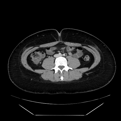 Normal Ct Abdomen And Pelvis Female Image 4566