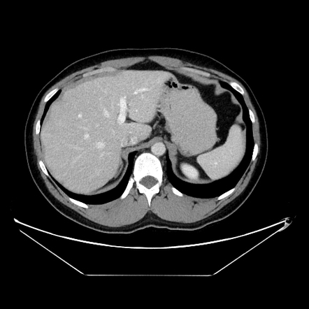 Normal CT of the abdomen and pelvis - male | Radiology Case ...