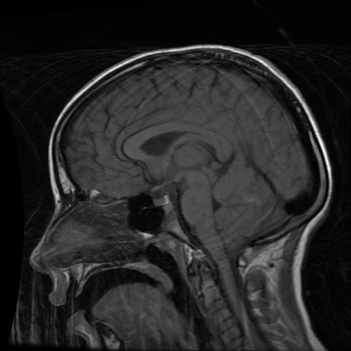 Dengue encephalitis | Image | Radiopaedia.org